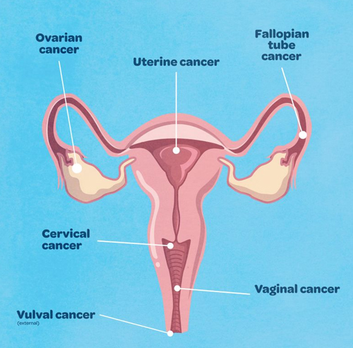 Best Doctor for Ovarian Cancer in Panchkula