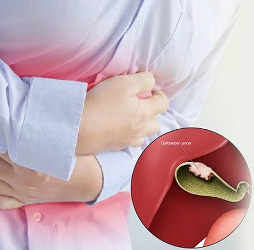 Gallbladder Cancer Specialist – Dr. Shivam Gaba, Leading Oncologist in Chandigarh 