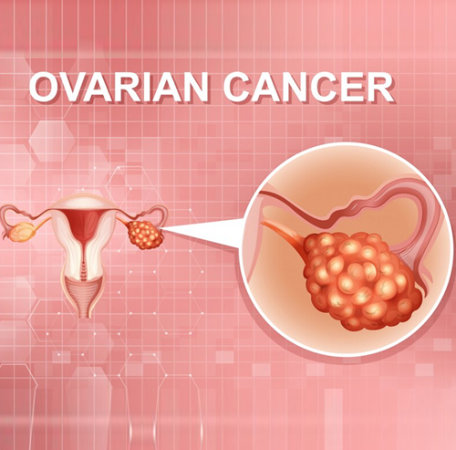 Ovarian Cancer Treatment by Dr. Shivam Gaba – Leading Oncologist in Chandigarh